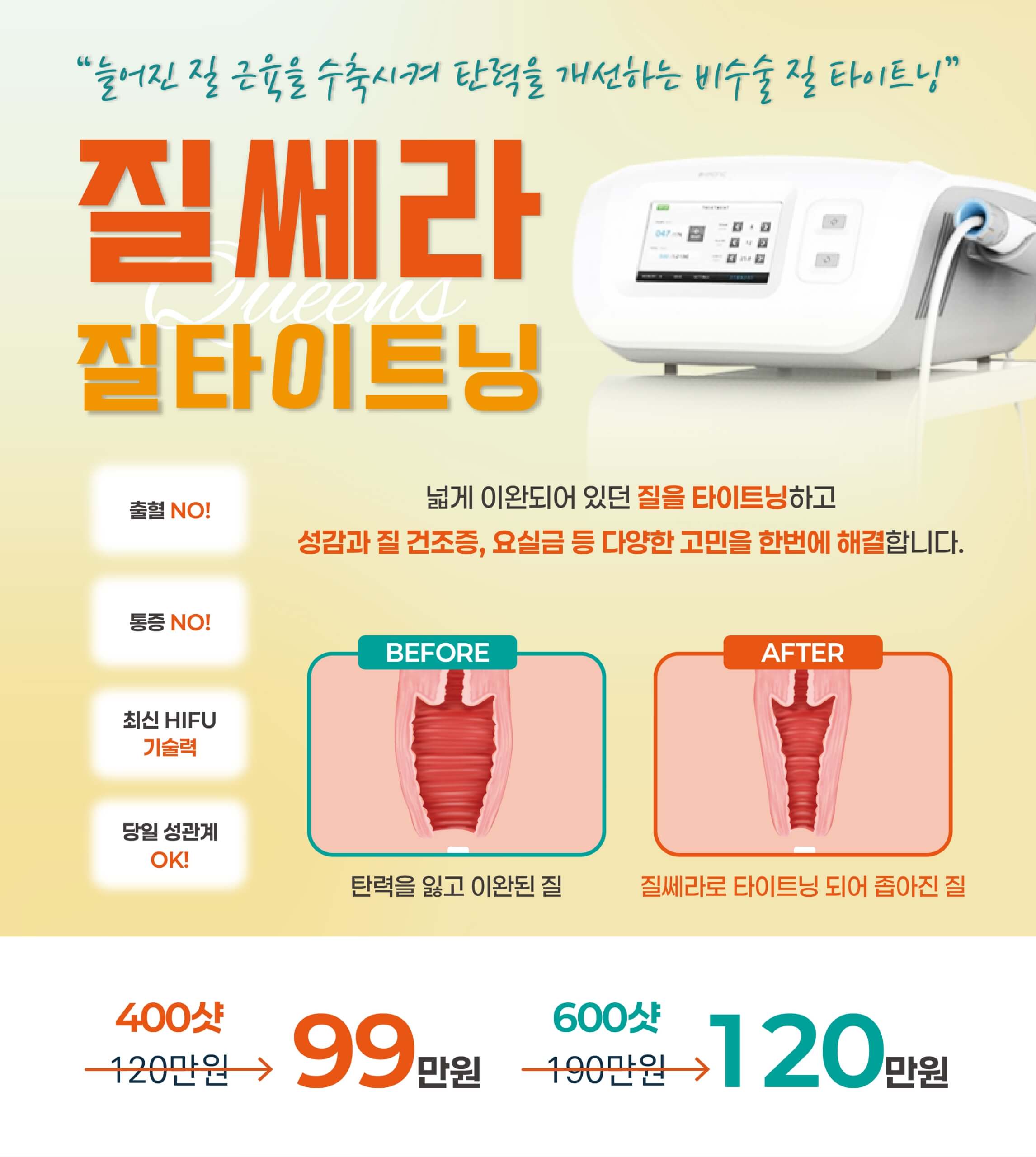질쎄라
